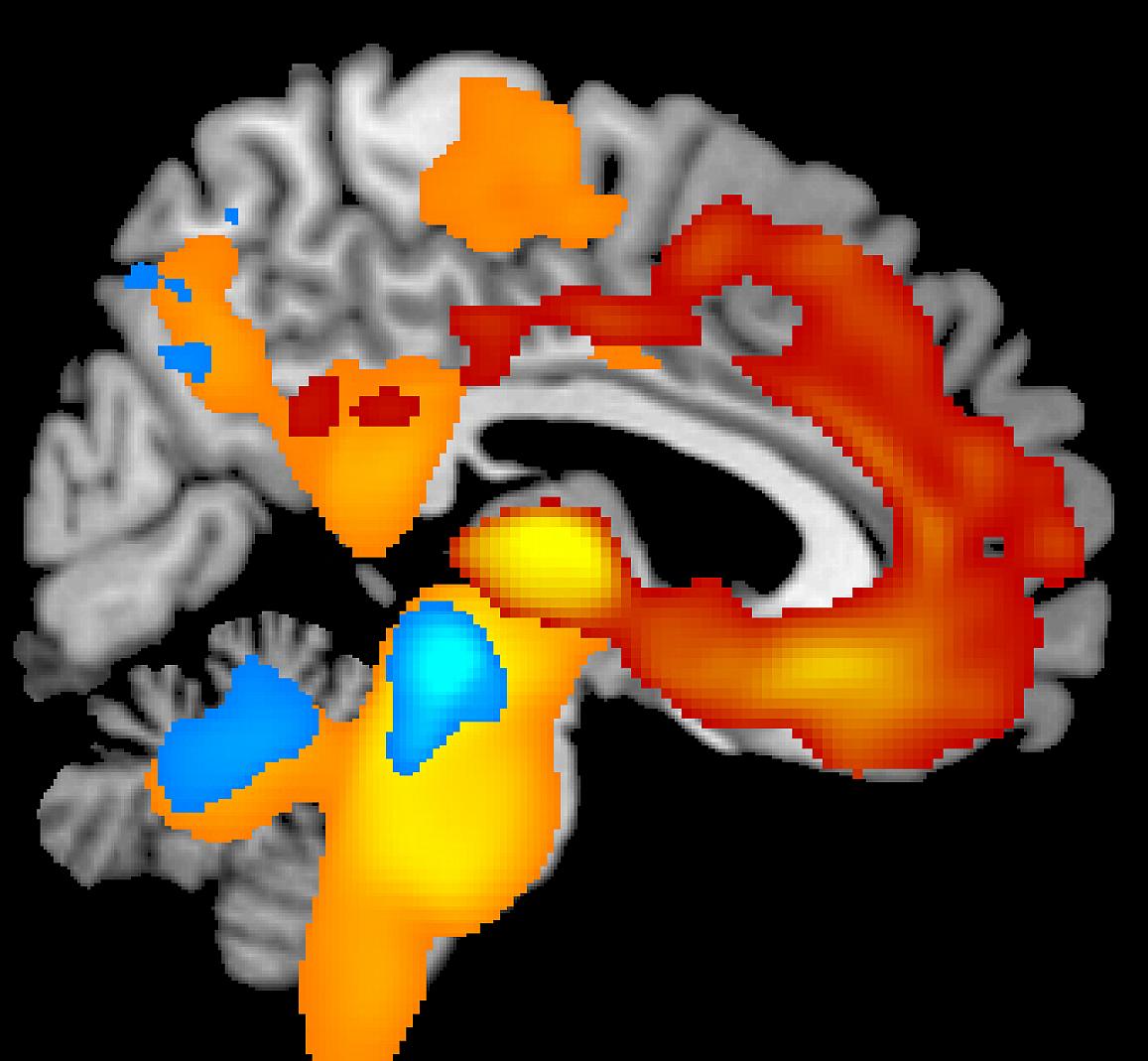 Adam L. Boxer M.D. Ph.D. who leads the RDCRN-supported Frontotemporal Lobar Degeneration (FTLD) Clinical Research Consortium is exploring a group of progressive brain diseases that damage brain networks controlling behavior cognition and movement. This image illustrates severe brain tissue loss over one year for patients with two types of FTLD: behavioral variant frontotemporal dementia