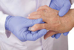 hand with Rhuematoid Arthritis