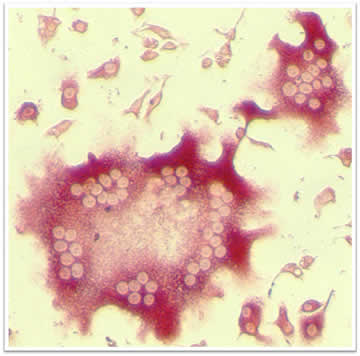 NIAMS scientists have found evidence that elevated numbers of osteoclasts a type of cell that degrades bone may contribute to bone loss in people with spondyloarthritis. Osteoclasts like the one shown here in the center contain multiple nuclei (clear circles) because they are formed by fusion of precursor cells. Credit: Robert A. Colbert M.D. Ph.D. NIAMS.