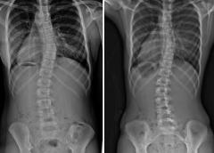 Before and after bracing x-rays of a girl with adolescent idiopathic scoliosis.