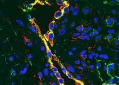 Blood vessels (outlined in yellow) of children with SAVI become inflamed