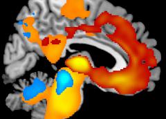 Adam L. Boxer M.D. Ph.D. who leads the RDCRN-supported Frontotemporal Lobar Degeneration (FTLD) Clinical Research Consortium is exploring a group of progressive brain diseases that damage brain networks controlling behavior cognition and movement. This image illustrates severe brain tissue loss over one year for patients with two types of FTLD: behavioral variant frontotemporal dementia