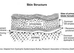 Epidermolysis bullosa occurs when genetic defects result in the skin’s two main layers not adhering properly at the dermal-epidermal junction.