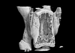 Vertebra from a mouse engineered to have osteogenesis imperfecta (upper panel). Following eight weeks of treatment with an antibody that blocks TGF-β activity the bone mass returned to normal levels (lower panel). Credit: Brendan Lee M.D. Ph.D. Baylor College of Medicine.