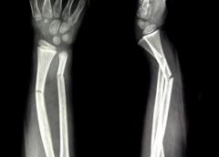 X-ray image of a child’s forearm fracture. Photo credit: eORIF LLC.