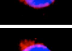 Photo of white blood cells one normal and one with NEMO mutation.