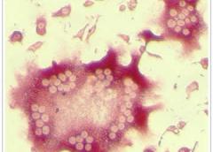 NIAMS scientists have found evidence that elevated numbers of osteoclasts a type of cell that degrades bone may contribute to bone loss in people with spondyloarthritis. Osteoclasts like the one shown here in the center contain multiple nuclei (clear circles) because they are formed by fusion of precursor cells. Credit: Robert A. Colbert M.D. Ph.D. NIAMS.