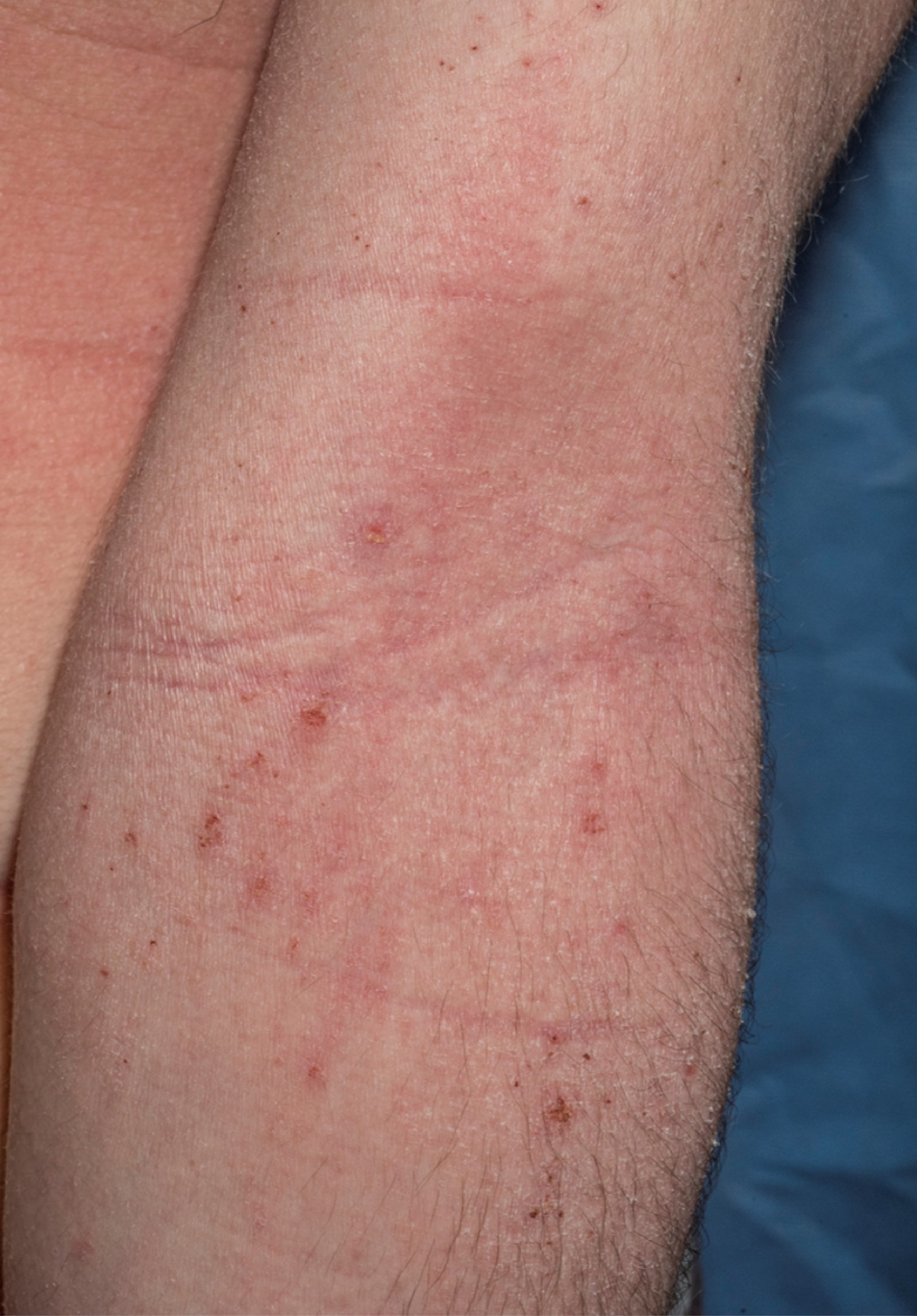 Eczema on arms