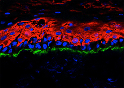 Correcting the Epidermolysis Bullosa Gene inforgraphic