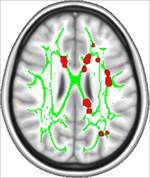 A map of chronic pain.