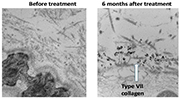 Electron microscope photo of two skin images, one treated with gene therapy and one untreated.