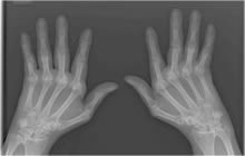 hands with rheumatoid arthritis